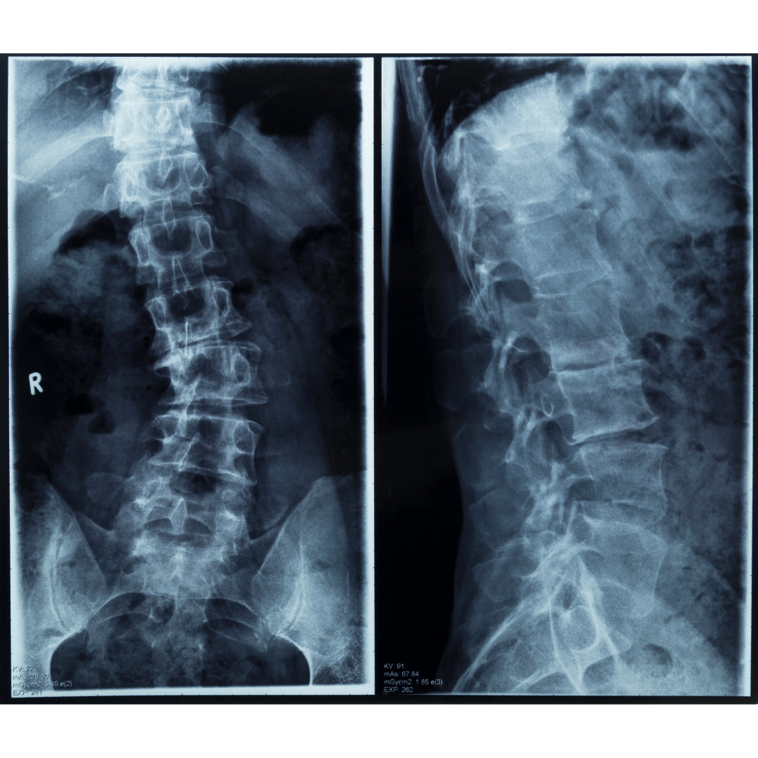 xrays of a person suffering from scoliosis and poor posture